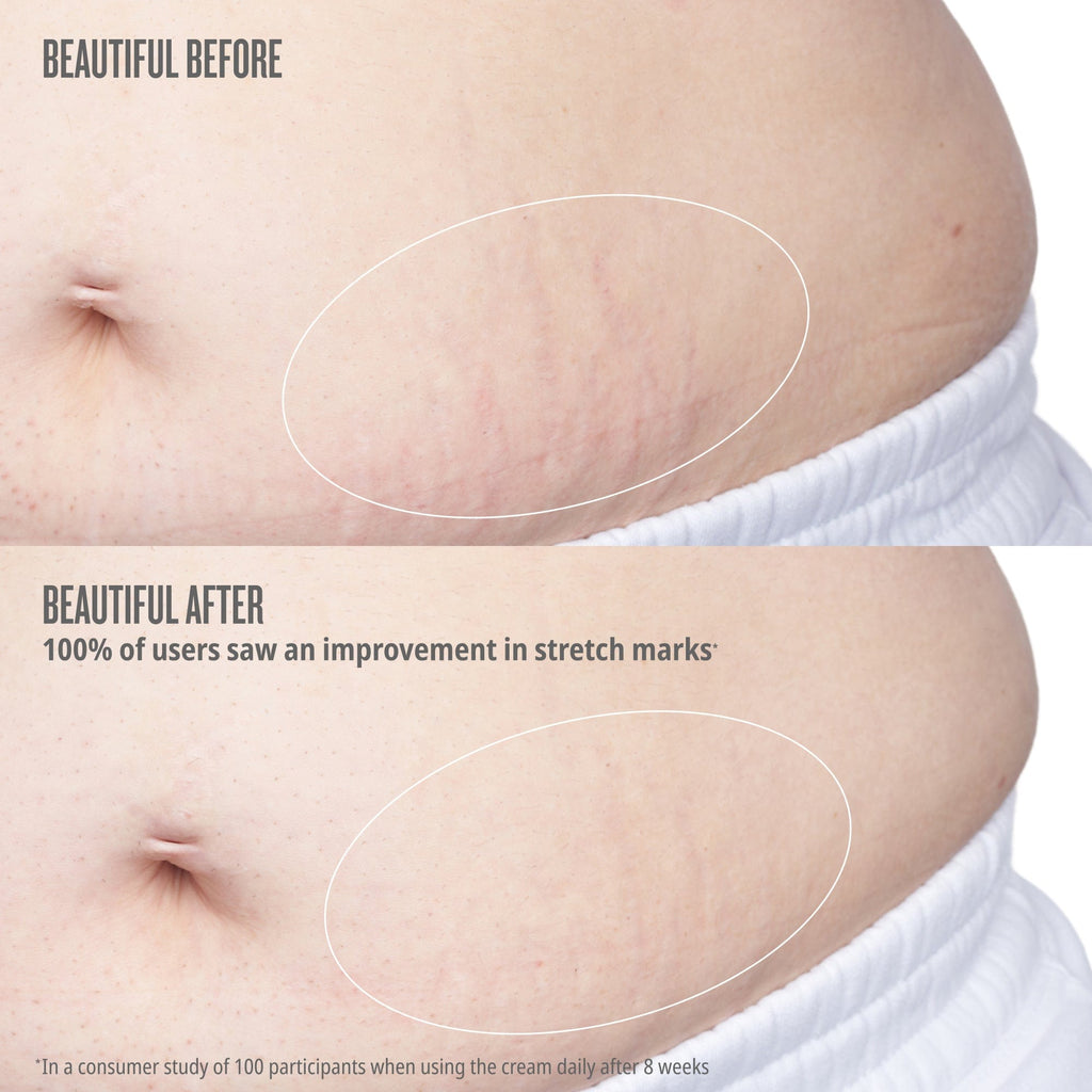 Before and after comparison of stretch marks on a person's skin with text indicating improvement.

Text on image reads beautiful before// beautiful after, after 8 weeks of 2x daily use, 100% of users saw an improvement in stretch marks 