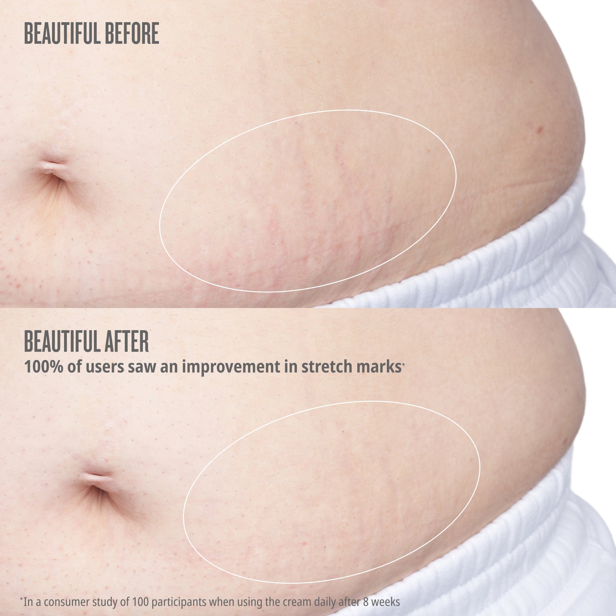 Before and after comparison of stretch marks on a person's skin with text indicating improvement.

Text on image reads beautiful before// beautiful after, after 8 weeks of 2x daily use, 100% of users saw an improvement in stretch marks 